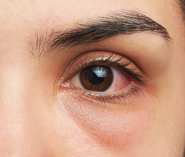 Swollen eyelid with pain discount